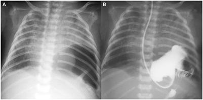 Rare Course of Bilateral Congenital Diaphragmatic Hernia Treated Thoracoscopically—Case Report